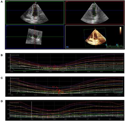 Assessment of Myocardial Dysfunction by Three-Dimensional Echocardiography Combined With Myocardial Contrast Echocardiography in Type 2 Diabetes Mellitus